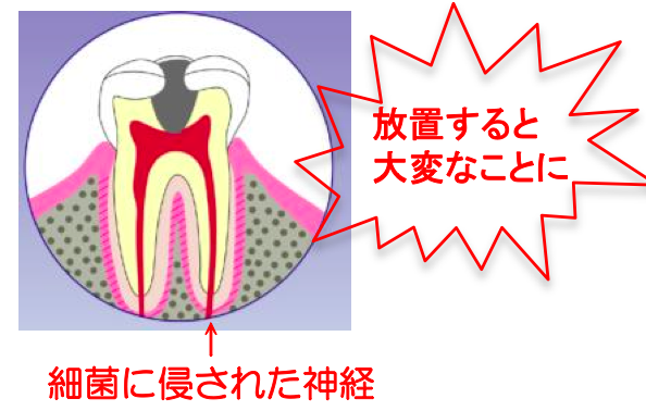 虫歯放置